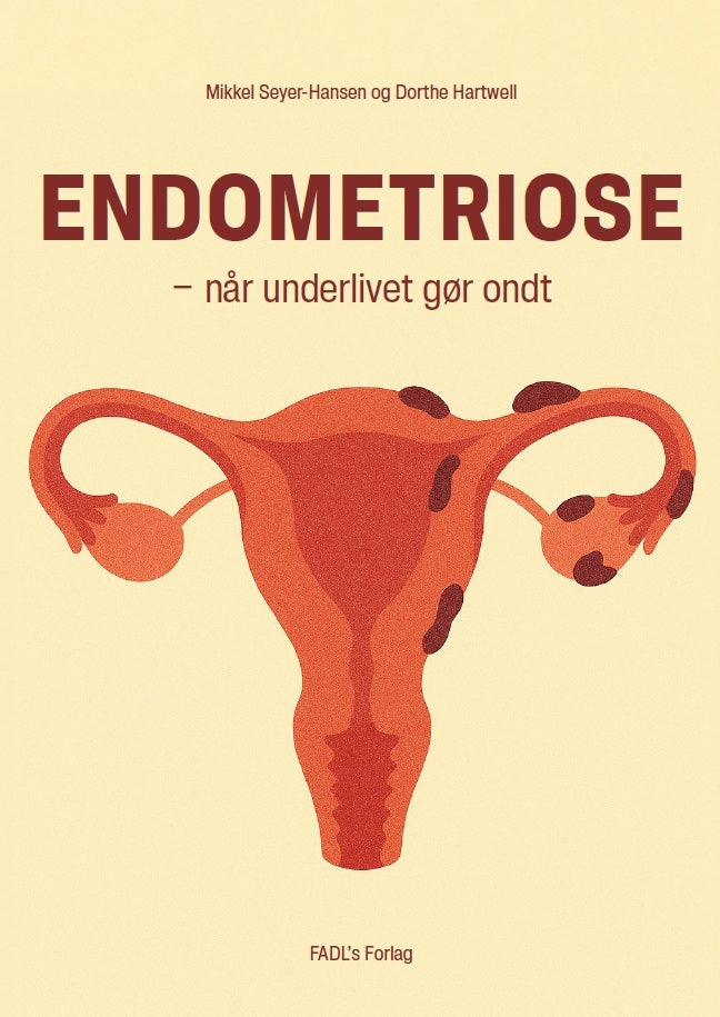 Endometriose – når underlivet gør ondt